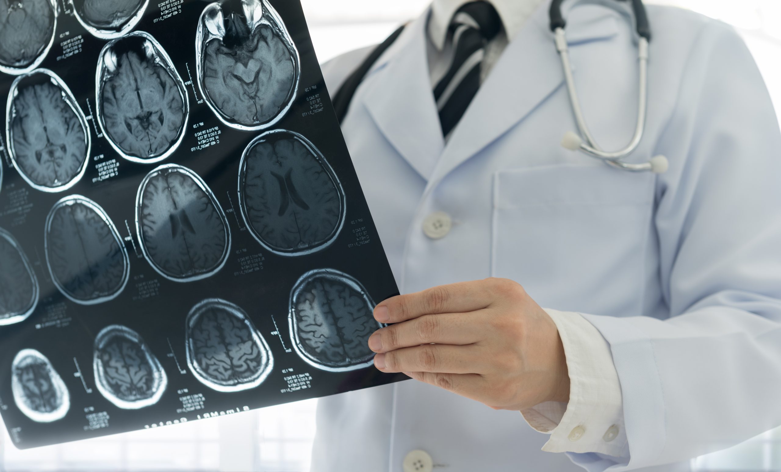 Brain MRI for diagnosis